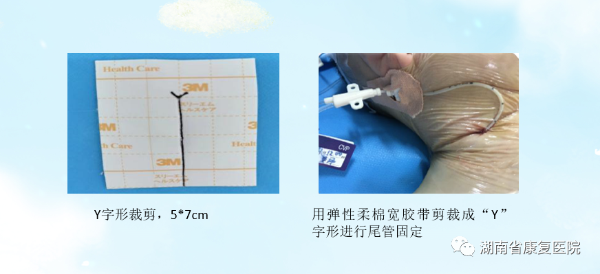 体表导管固定怎么使用用心呵护 “管”定安全——巧用弹性柔棉宽胶带制作导管固定贴_https://www.jmylbn.com_新闻资讯_第6张