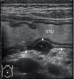 胃造影用的是什么机子胃肠超声造影--无创、无痛、无辐射！_https://www.jmylbn.com_新闻资讯_第13张