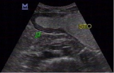 胃造影用的是什么机子胃肠超声造影--无创、无痛、无辐射！_https://www.jmylbn.com_新闻资讯_第10张