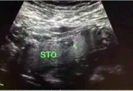 胃造影用的是什么机子胃肠超声造影--无创、无痛、无辐射！_https://www.jmylbn.com_新闻资讯_第11张