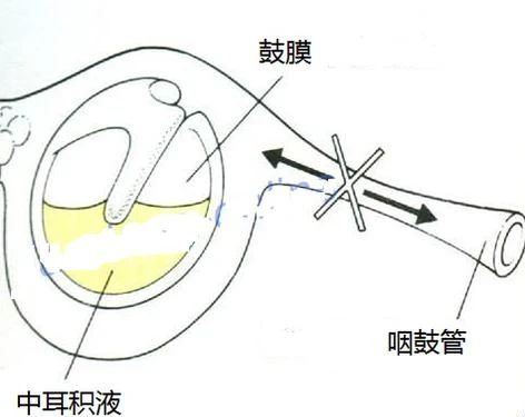 液体积聚在中耳腔内，会造成中耳腔积液，分泌性中耳炎就是这么形成的。