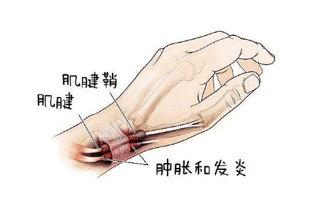 腱鞘炎的康复治疗_友友