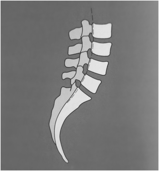 人体"小尾巴"尾骨的偏位及矫正-友友