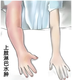 压力绷带为什么那么贵守护生命的每一步：从诊断到治疗的淋巴水肿之路_https://www.jmylbn.com_新闻资讯_第6张