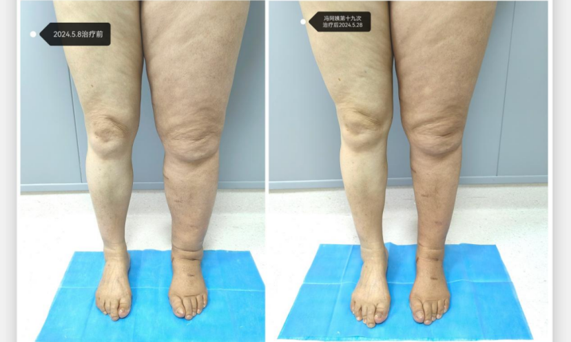 压力绷带为什么那么贵守护生命的每一步：从诊断到治疗的淋巴水肿之路_https://www.jmylbn.com_新闻资讯_第4张