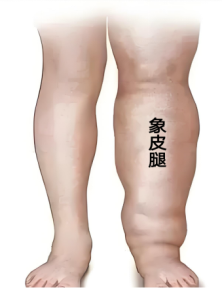 压力绷带为什么那么贵守护生命的每一步：从诊断到治疗的淋巴水肿之路_https://www.jmylbn.com_新闻资讯_第7张