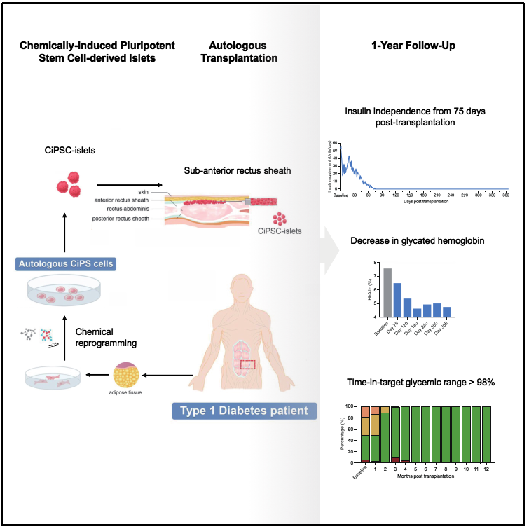 基于化学重编程诱导多能干细胞治疗1型糖尿病的临床研究的示意图和治疗效果。（受访单位供图）