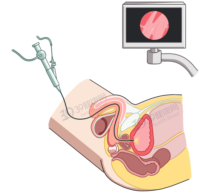 膀胱镜检查难受图片