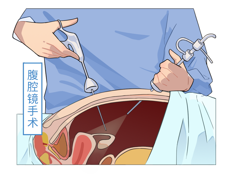 手术女性结扎它也没有那么恐怖但实际上有一半可能来源于疼痛大家对