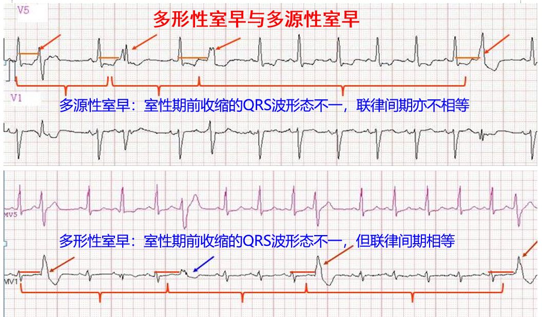 当麻醉遇上室性早搏_医学界-助力医生临床决策和职业成长