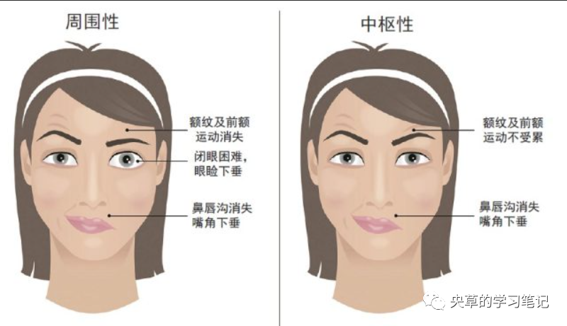 针灸|面部中风（面瘫）的治疗-搜博