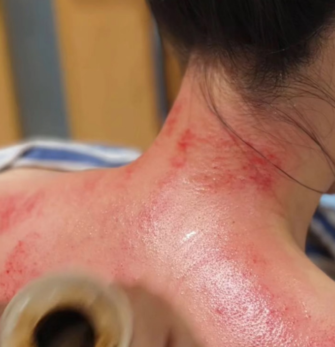 用刮痧板自己怎么刮脸身体有結节、淤堵的人，这个地方会鼓包_https://www.jmylbn.com_新闻资讯_第3张