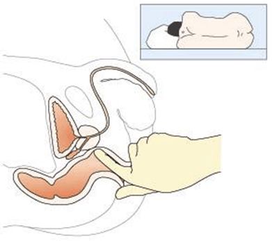 一次性肛门镜怎么检查肛肠科常见疾病检查操作_https://www.jmylbn.com_新闻资讯_第1张