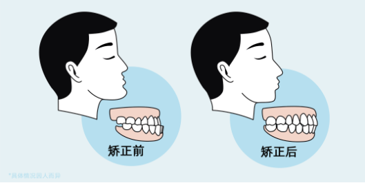 口腔科普关于牙齿正畸常见的五个问题