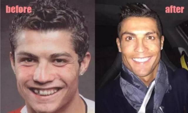 堪比整容的矫牙，到底有没有风险？