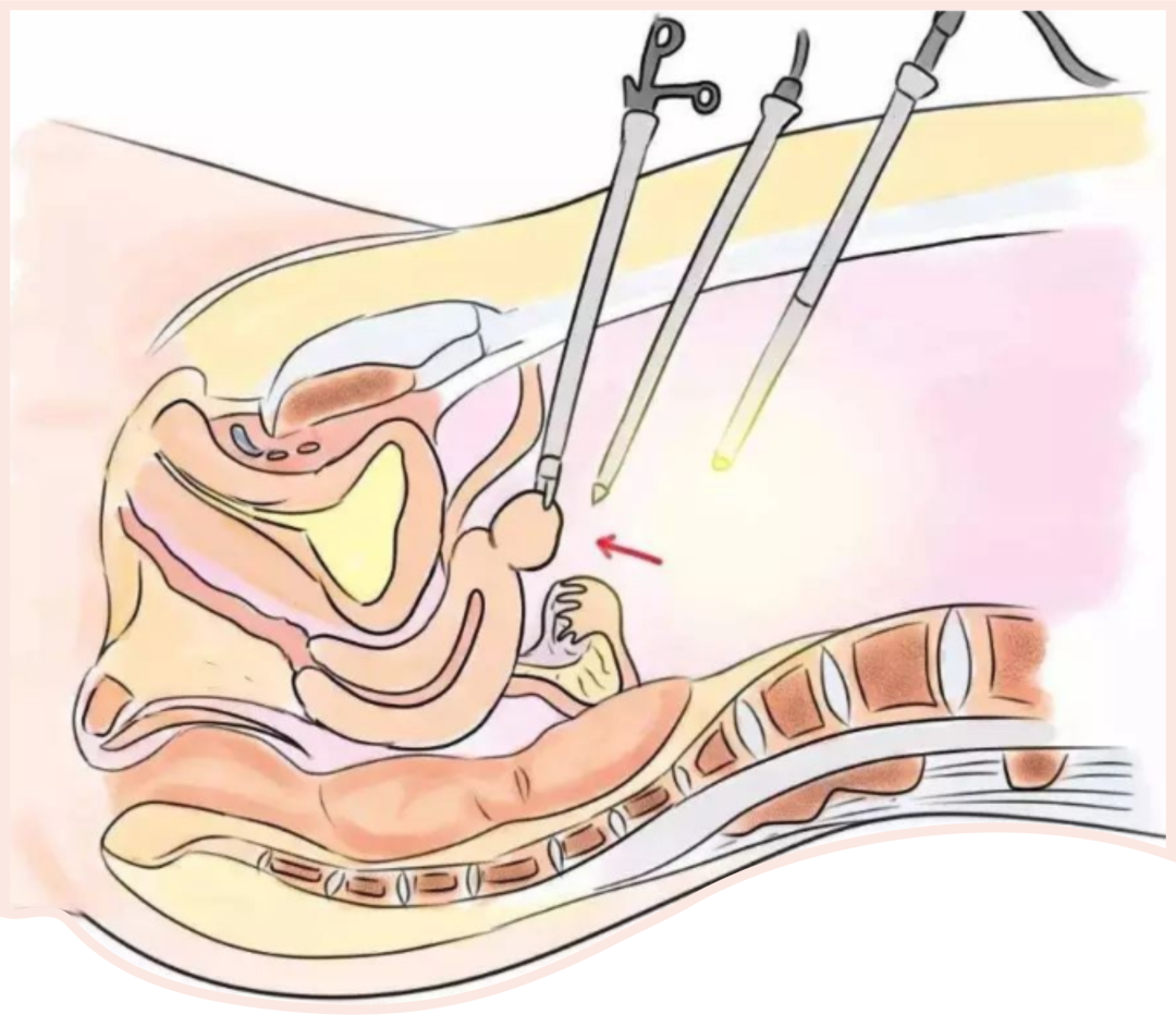 手术钳怎么拿【临床知识】腹腔镜器械知识普及_https://www.jmylbn.com_新闻资讯_第5张