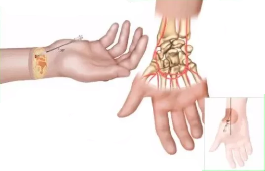 动脉长鞘怎么置入【临床知识】桡动脉穿刺技巧细节要知道_https://www.jmylbn.com_新闻资讯_第5张