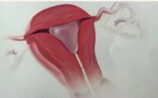 子宫球囊支架怎么取【产品介绍】球囊子宫支架知识普及_https://www.jmylbn.com_新闻资讯_第7张