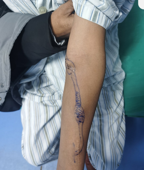 【精术】河池市三医院肾内科开展DSA引导下血透通路腔内介入治疗减轻血透患者痛苦