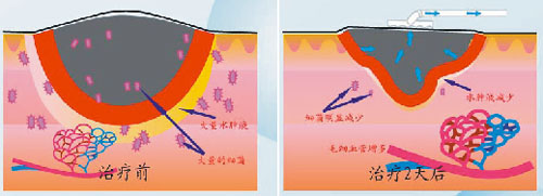 伤口负压治疗怎么收费负压创面治疗法：让难愈创面的治疗更轻便_https://www.jmylbn.com_新闻资讯_第10张