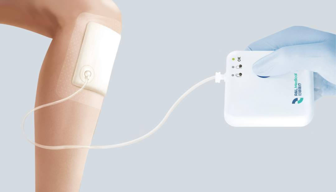 伤口负压治疗怎么收费负压创面治疗法：让难愈创面的治疗更轻便_https://www.jmylbn.com_新闻资讯_第12张