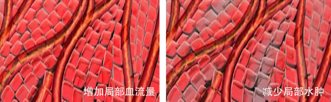 伤口负压治疗怎么收费负压创面治疗法：让难愈创面的治疗更轻便_https://www.jmylbn.com_新闻资讯_第8张