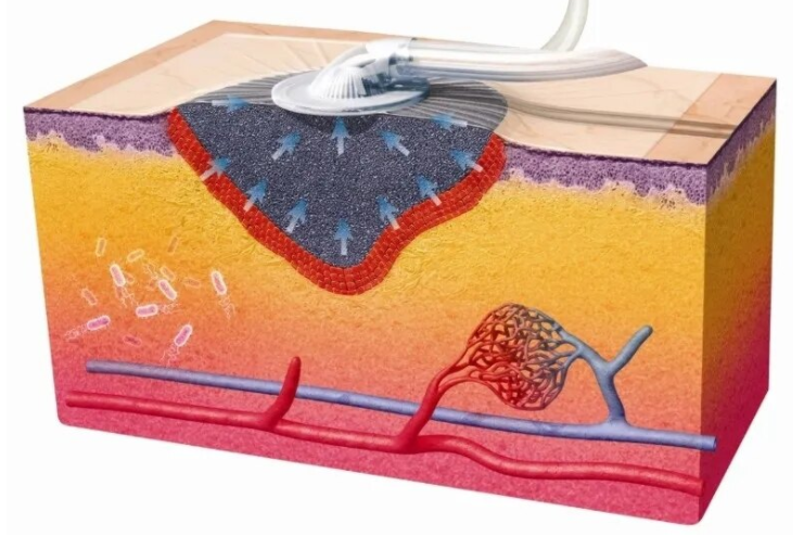 伤口负压治疗怎么收费负压创面治疗法：让难愈创面的治疗更轻便_https://www.jmylbn.com_新闻资讯_第7张