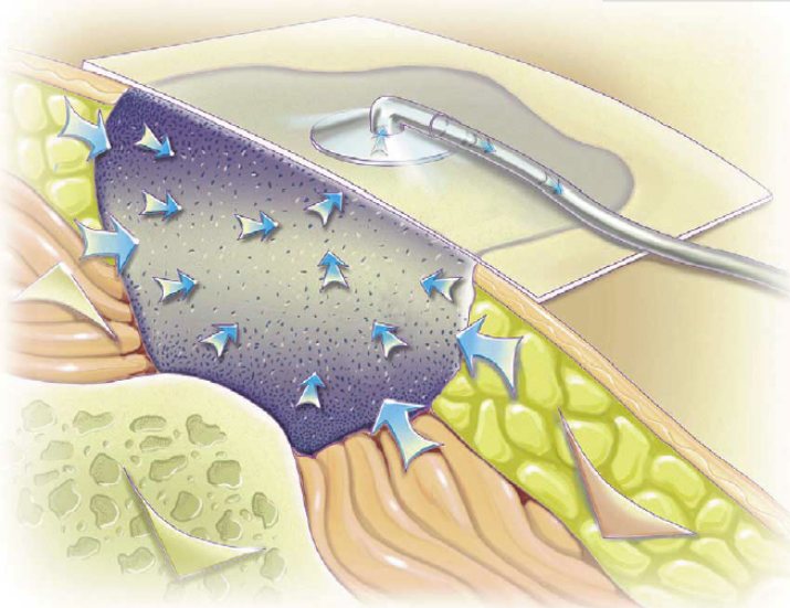 伤口负压治疗怎么收费负压创面治疗法：让难愈创面的治疗更轻便_https://www.jmylbn.com_新闻资讯_第4张