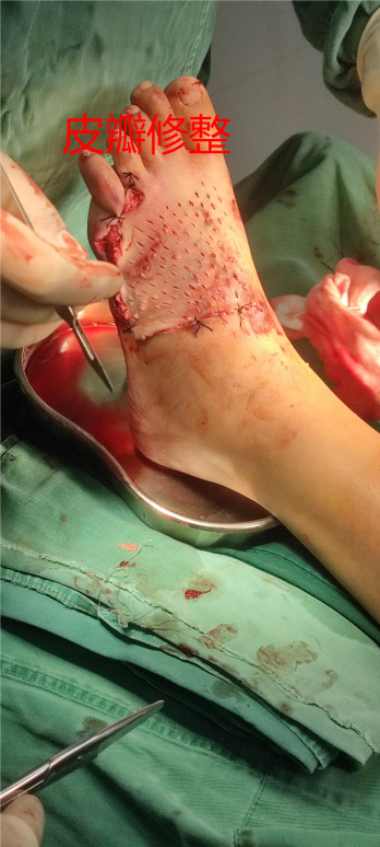 什么是vsd负压引流负压封闭引流技术丨VSD技术的使用_https://www.jmylbn.com_新闻资讯_第2张