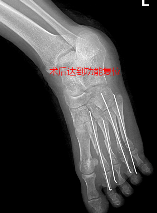 什么是vsd负压引流负压封闭引流技术丨VSD技术的使用_https://www.jmylbn.com_新闻资讯_第6张