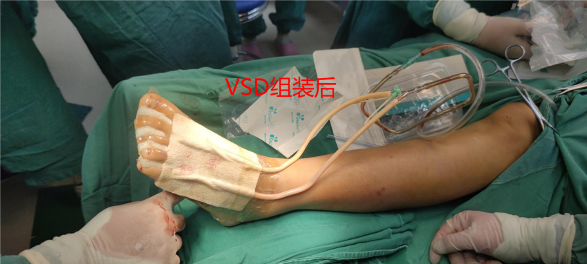 什么是vsd负压引流负压封闭引流技术丨VSD技术的使用_https://www.jmylbn.com_新闻资讯_第3张