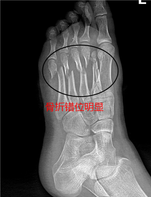 什么是vsd负压引流负压封闭引流技术丨VSD技术的使用_https://www.jmylbn.com_新闻资讯_第5张