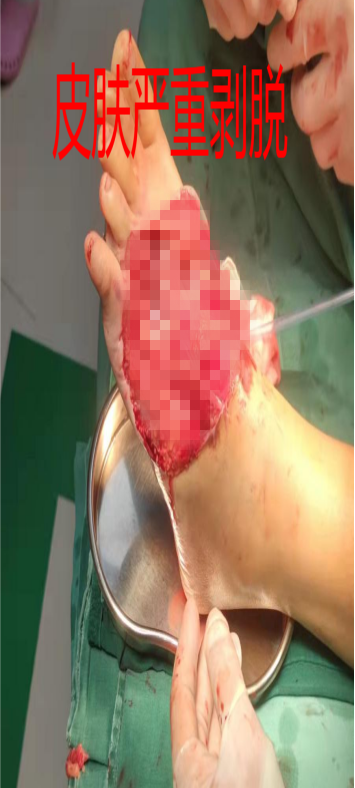 什么是vsd负压引流负压封闭引流技术丨VSD技术的使用_https://www.jmylbn.com_新闻资讯_第1张