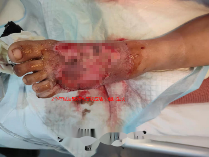 什么是vsd负压引流负压封闭引流技术丨VSD技术的使用_https://www.jmylbn.com_新闻资讯_第4张