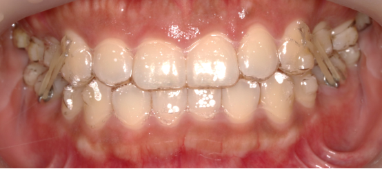 牙科材料硅胶怎么用如何使用咬胶？试试这些小技巧！_https://www.jmylbn.com_新闻资讯_第8张