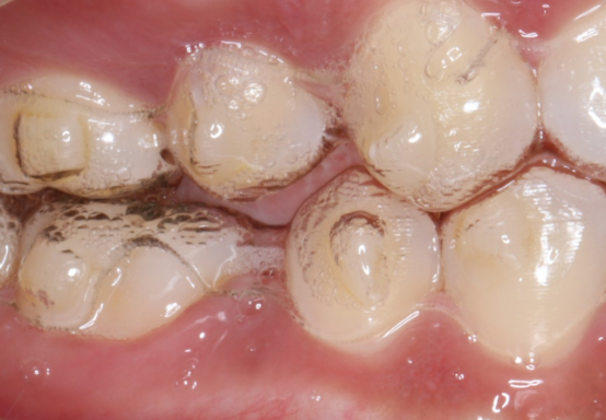 牙科材料硅胶怎么用如何使用咬胶？试试这些小技巧！_https://www.jmylbn.com_新闻资讯_第7张