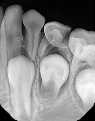 X光拍片为什么要等小朋友看牙为什么要拍片？_https://www.jmylbn.com_新闻资讯_第9张
