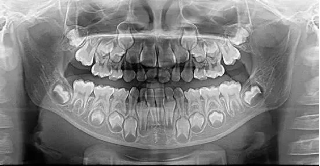 X光拍片为什么要等小朋友看牙为什么要拍片？_https://www.jmylbn.com_新闻资讯_第8张