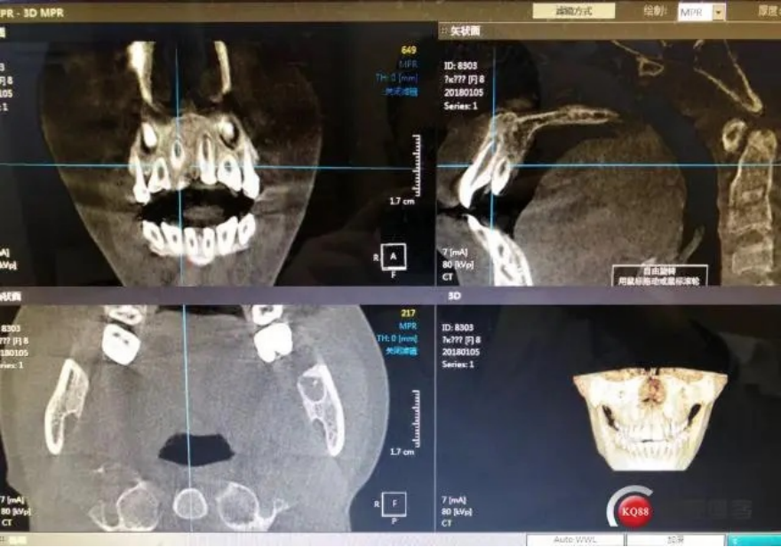X光拍片为什么要等小朋友看牙为什么要拍片？_https://www.jmylbn.com_新闻资讯_第10张