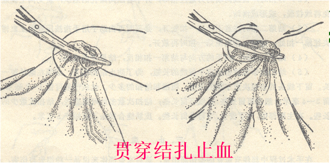 为什么要结扎血管谈骨论筋丨最全的外科手术基本功，别怪我没告诉你！_https://www.jmylbn.com_新闻资讯_第26张