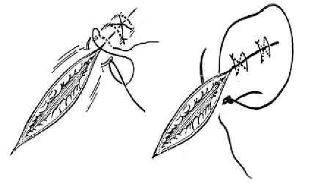 为什么要结扎血管谈骨论筋丨最全的外科手术基本功，别怪我没告诉你！_https://www.jmylbn.com_新闻资讯_第31张
