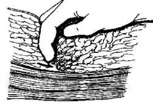 为什么要结扎血管谈骨论筋丨最全的外科手术基本功，别怪我没告诉你！_https://www.jmylbn.com_新闻资讯_第23张