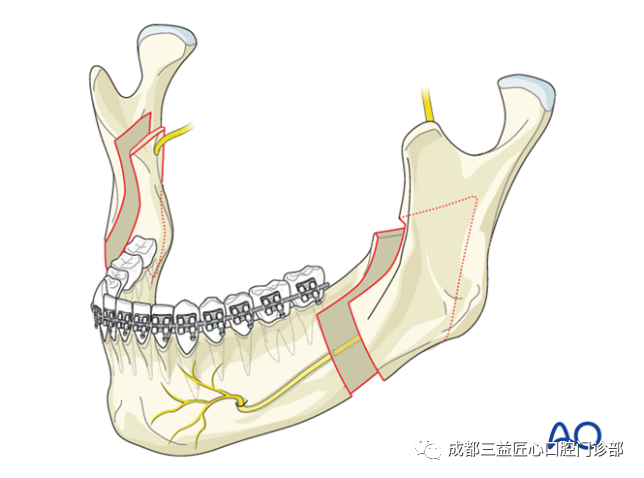 正颌就是动骨头一篇关于正颌手术的科普
