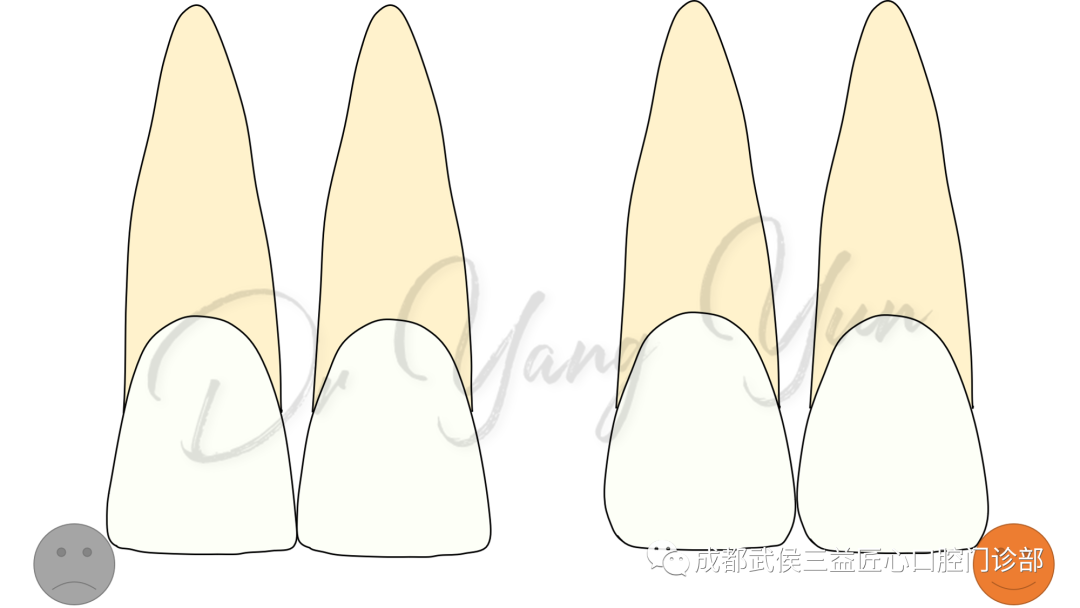 牙冠形态决定了接触区的位置,从而直接影响黑三角的发生概率.