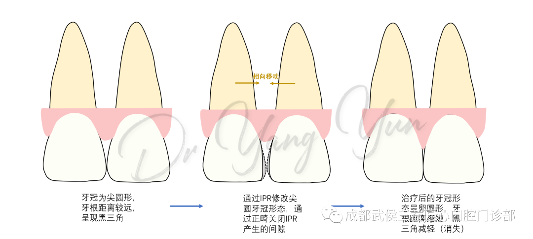 面接触区与牙槽嵴顶之间的距离,诱导龈乳头的形成从而改善黑三角问题