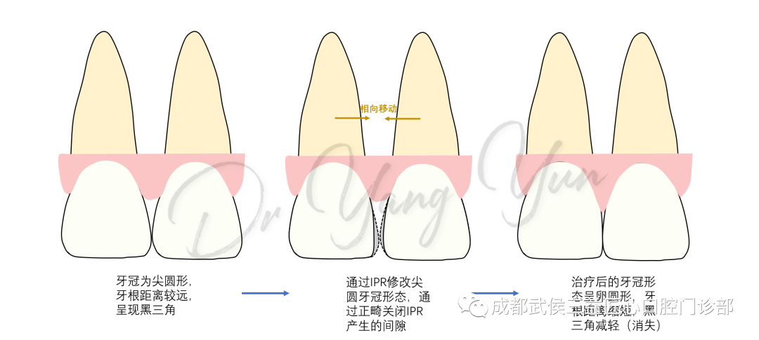 牙齿邻面接触点位置图片