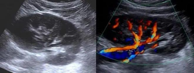 多普勒彩超图怎么看超声科冷知识：为什么彩超不是彩色的？_https://www.jmylbn.com_新闻资讯_第3张