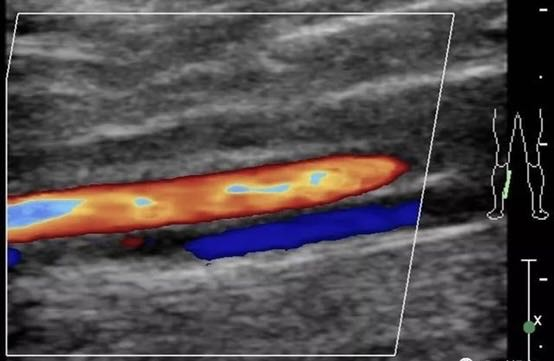 多普勒彩超图怎么看超声科冷知识：为什么彩超不是彩色的？_https://www.jmylbn.com_新闻资讯_第5张