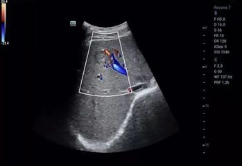 多普勒彩超图怎么看超声科冷知识：为什么彩超不是彩色的？_https://www.jmylbn.com_新闻资讯_第4张