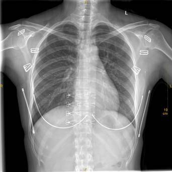 X光拍片为什么要等【影像科普】拍片为什么会要求脱衣服？_https://www.jmylbn.com_新闻资讯_第4张